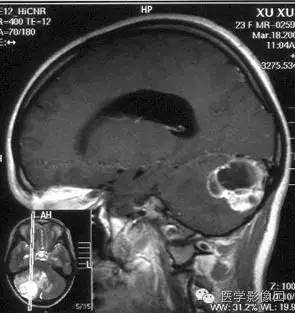 【病例】小脑血管母细胞瘤 【病例】小脑血管母细胞瘤
