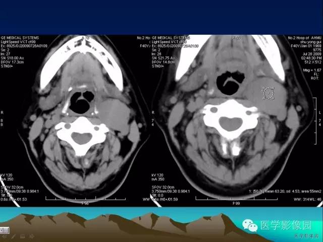 【病例】颈动脉体副神经节细胞瘤1例CT影像表现 【病例】颈动脉体副神经节细胞瘤1例CT影像表现