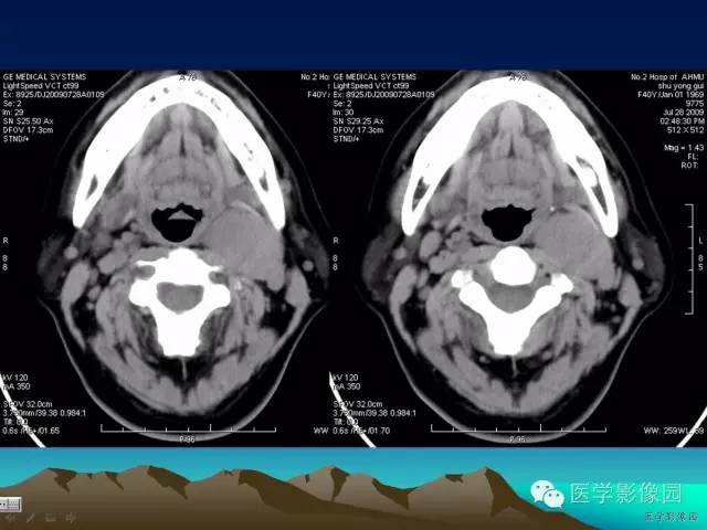 【病例】颈动脉体副神经节细胞瘤1例CT影像表现 【病例】颈动脉体副神经节细胞瘤1例CT影像表现