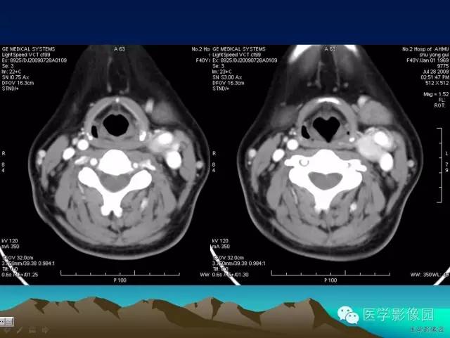【病例】颈动脉体副神经节细胞瘤1例CT影像表现 【病例】颈动脉体副神经节细胞瘤1例CT影像表现