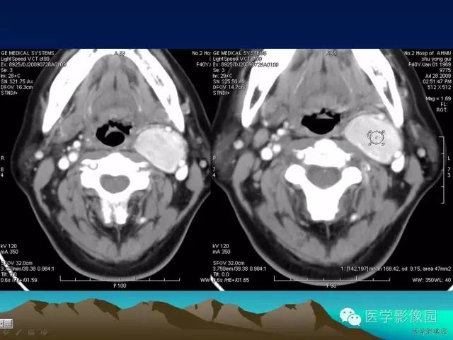 【病例】颈动脉体副神经节细胞瘤1例CT影像表现 【病例】颈动脉体副神经节细胞瘤1例CT影像表现