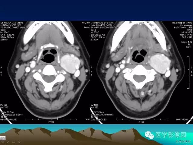【病例】颈动脉体副神经节细胞瘤1例CT影像表现 【病例】颈动脉体副神经节细胞瘤1例CT影像表现