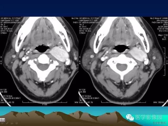 【病例】颈动脉体副神经节细胞瘤1例CT影像表现 【病例】颈动脉体副神经节细胞瘤1例CT影像表现