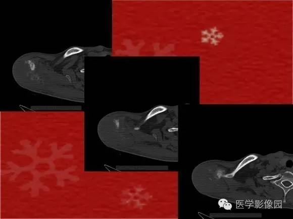【病例】肩胛骨尤文氏肉瘤1例CT影像表现 【病例】肩胛骨尤文氏肉瘤1例CT影像表现