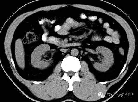 【病例】腹腔神经鞘瘤1例CT影像表现