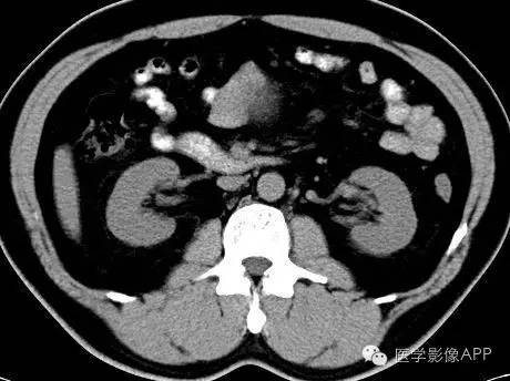【病例】腹腔神经鞘瘤1例CT影像表现 【病例】腹腔神经鞘瘤1例CT影像表现
