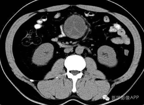 【病例】腹腔神经鞘瘤1例CT影像表现 【病例】腹腔神经鞘瘤1例CT影像表现