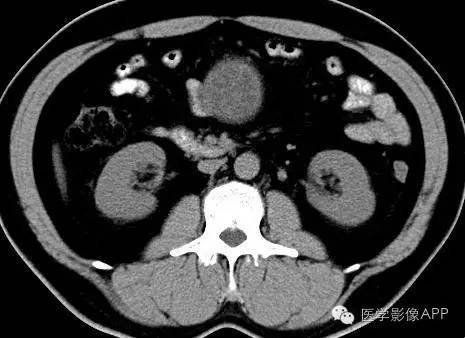 【病例】腹腔神经鞘瘤1例CT影像表现 【病例】腹腔神经鞘瘤1例CT影像表现