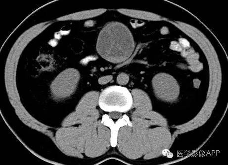 【病例】腹腔神经鞘瘤1例CT影像表现 【病例】腹腔神经鞘瘤1例CT影像表现