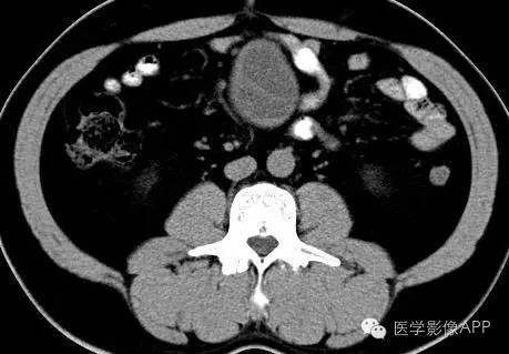 【病例】腹腔神经鞘瘤1例CT影像表现 【病例】腹腔神经鞘瘤1例CT影像表现