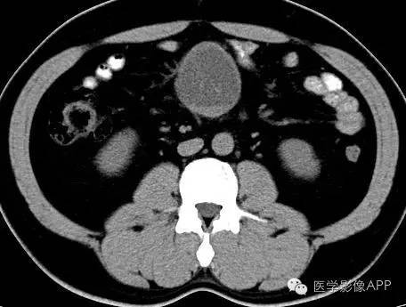 【病例】腹腔神经鞘瘤1例CT影像表现 【病例】腹腔神经鞘瘤1例CT影像表现