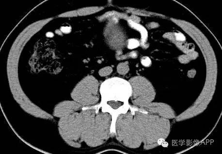 【病例】腹腔神经鞘瘤1例CT影像表现 【病例】腹腔神经鞘瘤1例CT影像表现