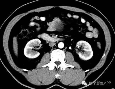 【病例】腹腔神经鞘瘤1例CT影像表现 【病例】腹腔神经鞘瘤1例CT影像表现