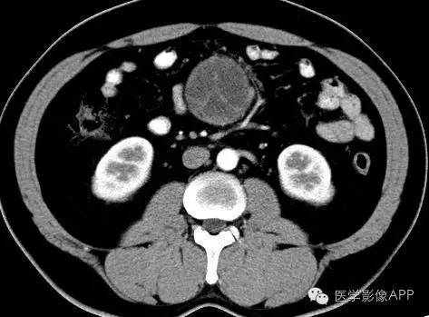 【病例】腹腔神经鞘瘤1例CT影像表现 【病例】腹腔神经鞘瘤1例CT影像表现