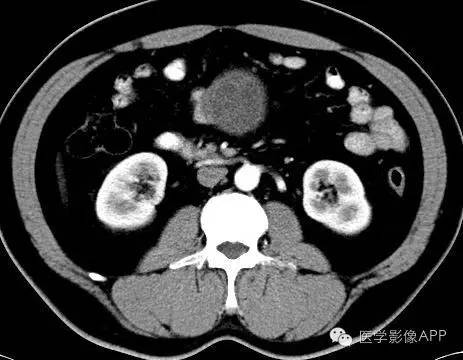 【病例】腹腔神经鞘瘤1例CT影像表现 【病例】腹腔神经鞘瘤1例CT影像表现