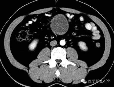 【病例】腹腔神经鞘瘤1例CT影像表现 【病例】腹腔神经鞘瘤1例CT影像表现