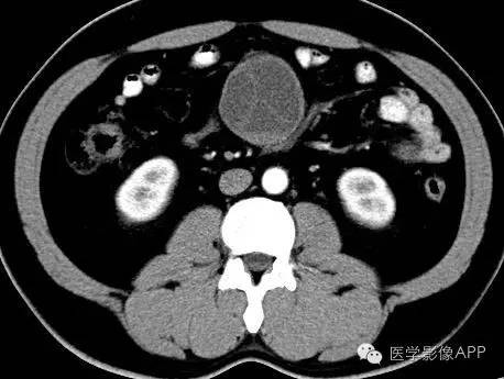 【病例】腹腔神经鞘瘤1例CT影像表现 【病例】腹腔神经鞘瘤1例CT影像表现