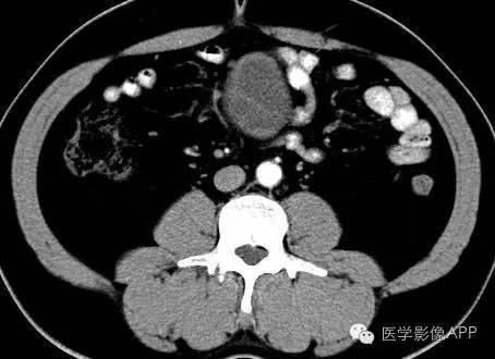 【病例】腹腔神经鞘瘤1例CT影像表现 【病例】腹腔神经鞘瘤1例CT影像表现