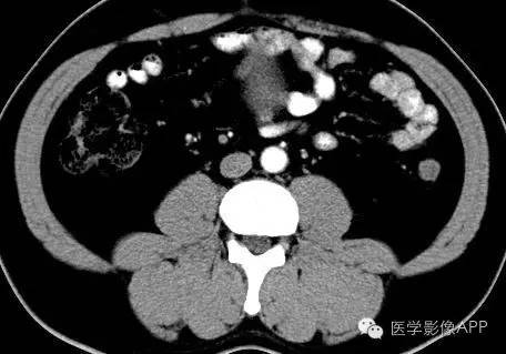 【病例】腹腔神经鞘瘤1例CT影像表现 【病例】腹腔神经鞘瘤1例CT影像表现