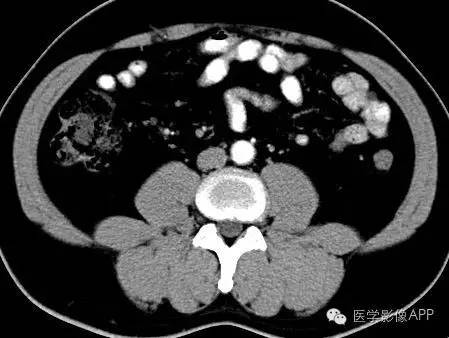 【病例】腹腔神经鞘瘤1例CT影像表现 【病例】腹腔神经鞘瘤1例CT影像表现