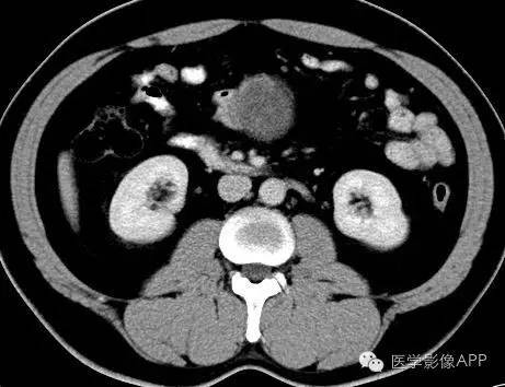 【病例】腹腔神经鞘瘤1例CT影像表现 【病例】腹腔神经鞘瘤1例CT影像表现