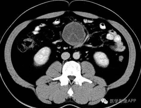 【病例】腹腔神经鞘瘤1例CT影像表现 【病例】腹腔神经鞘瘤1例CT影像表现