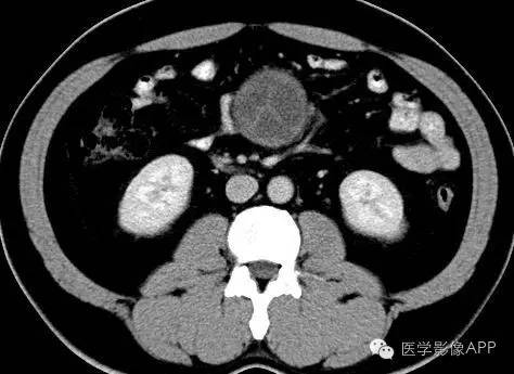 【病例】腹腔神经鞘瘤1例CT影像表现 【病例】腹腔神经鞘瘤1例CT影像表现