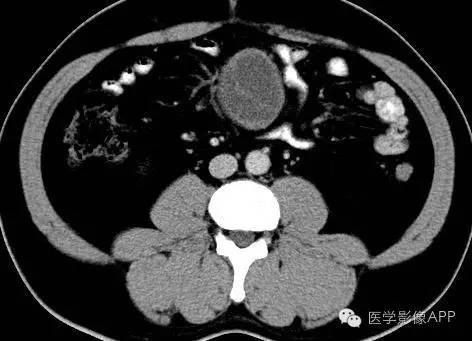 【病例】腹腔神经鞘瘤1例CT影像表现 【病例】腹腔神经鞘瘤1例CT影像表现