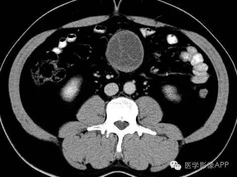 【病例】腹腔神经鞘瘤1例CT影像表现 【病例】腹腔神经鞘瘤1例CT影像表现