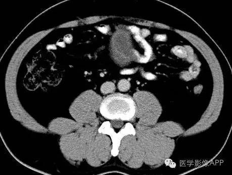 【病例】腹腔神经鞘瘤1例CT影像表现 【病例】腹腔神经鞘瘤1例CT影像表现