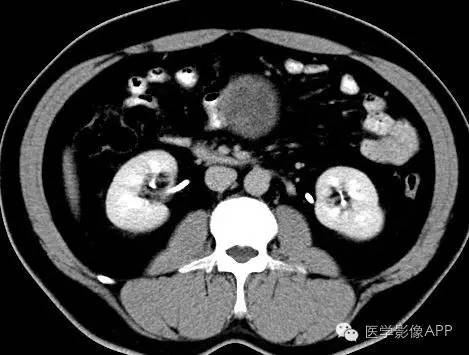 【病例】腹腔神经鞘瘤1例CT影像表现 【病例】腹腔神经鞘瘤1例CT影像表现