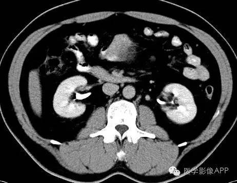 【病例】腹腔神经鞘瘤1例CT影像表现 【病例】腹腔神经鞘瘤1例CT影像表现