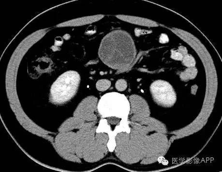 【病例】腹腔神经鞘瘤1例CT影像表现 【病例】腹腔神经鞘瘤1例CT影像表现