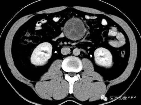 【病例】腹腔神经鞘瘤1例CT影像表现 【病例】腹腔神经鞘瘤1例CT影像表现