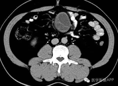 【病例】腹腔神经鞘瘤1例CT影像表现 【病例】腹腔神经鞘瘤1例CT影像表现