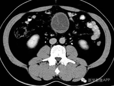 【病例】腹腔神经鞘瘤1例CT影像表现 【病例】腹腔神经鞘瘤1例CT影像表现