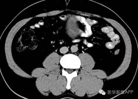 【病例】腹腔神经鞘瘤1例CT影像表现 【病例】腹腔神经鞘瘤1例CT影像表现