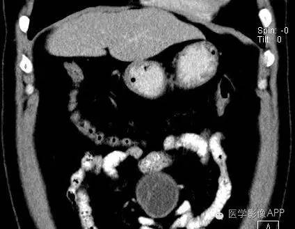【病例】腹腔神经鞘瘤1例CT影像表现 【病例】腹腔神经鞘瘤1例CT影像表现