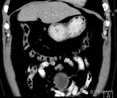 【病例】腹腔神经鞘瘤1例CT影像表现 【病例】腹腔神经鞘瘤1例CT影像表现