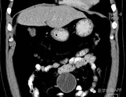 【病例】腹腔神经鞘瘤1例CT影像表现 【病例】腹腔神经鞘瘤1例CT影像表现