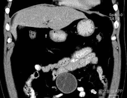 【病例】腹腔神经鞘瘤1例CT影像表现 【病例】腹腔神经鞘瘤1例CT影像表现