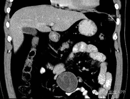 【病例】腹腔神经鞘瘤1例CT影像表现 【病例】腹腔神经鞘瘤1例CT影像表现