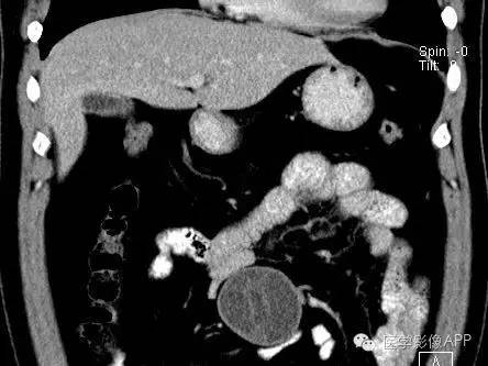 【病例】腹腔神经鞘瘤1例CT影像表现 【病例】腹腔神经鞘瘤1例CT影像表现