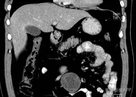 【病例】腹腔神经鞘瘤1例CT影像表现 【病例】腹腔神经鞘瘤1例CT影像表现