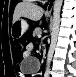 【病例】腹腔神经鞘瘤1例CT影像表现 【病例】腹腔神经鞘瘤1例CT影像表现