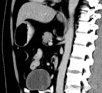 【病例】腹腔神经鞘瘤1例CT影像表现 【病例】腹腔神经鞘瘤1例CT影像表现
