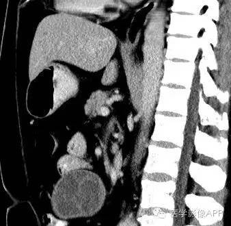 【病例】腹腔神经鞘瘤1例CT影像表现 【病例】腹腔神经鞘瘤1例CT影像表现