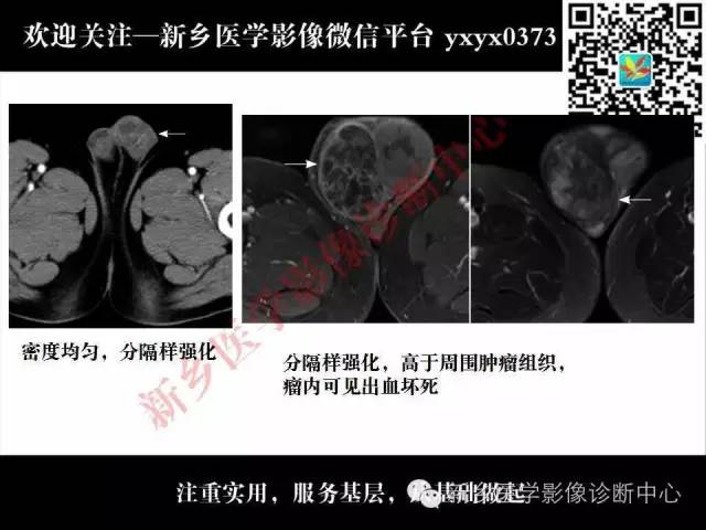 【PPT】睾丸肿瘤影像诊断