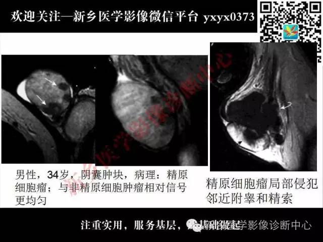 【PPT】睾丸肿瘤影像诊断
