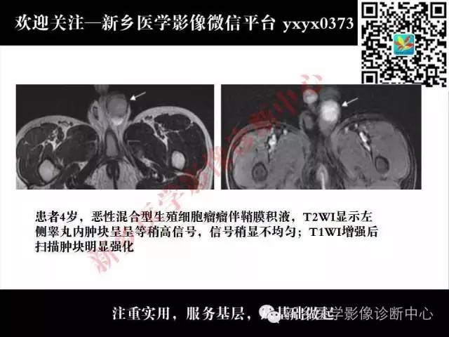 【PPT】睾丸肿瘤影像诊断
